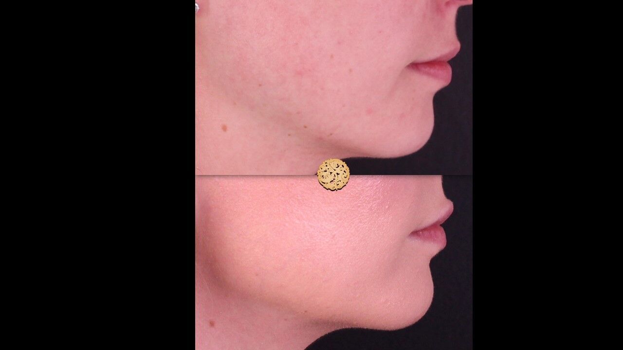 Lip Filler Before & After