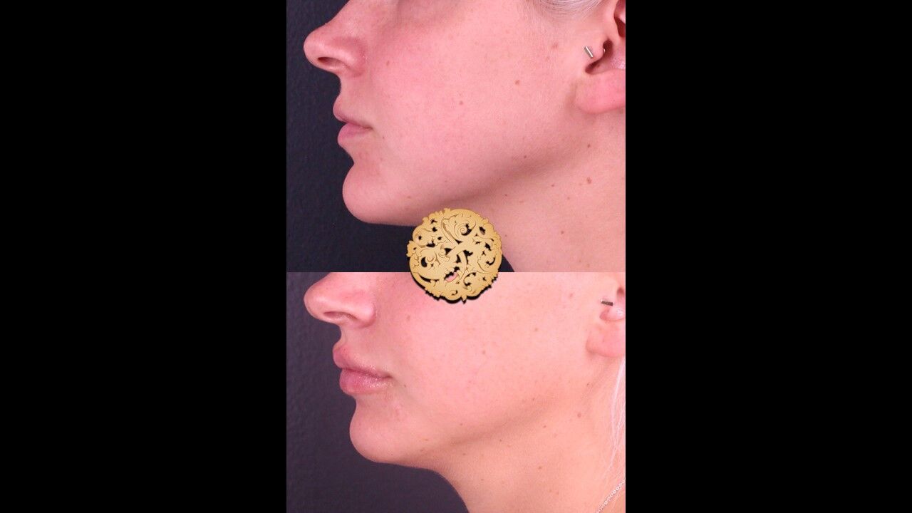 Lip Filler Before & After