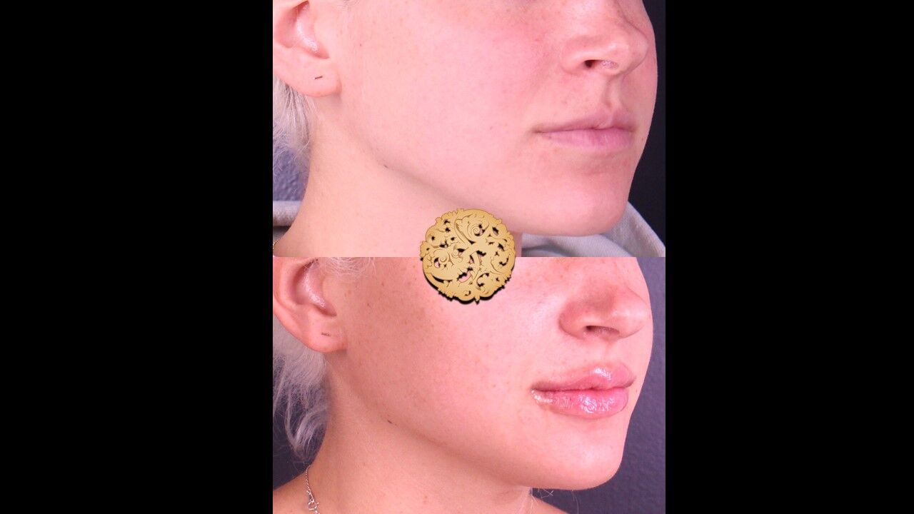 Lip Filler Before & After