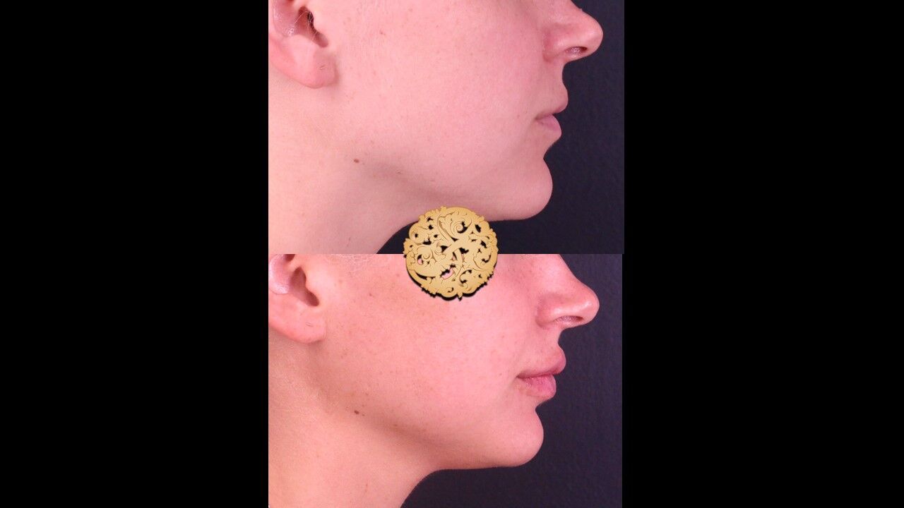 Lip Filler Before & After