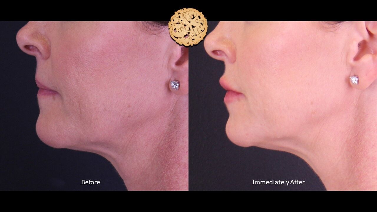 Lip Filler Before & After