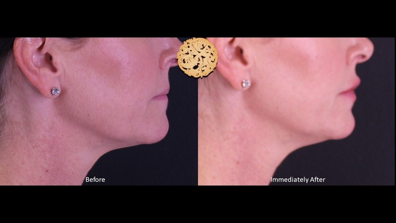 Lip Filler Before & After