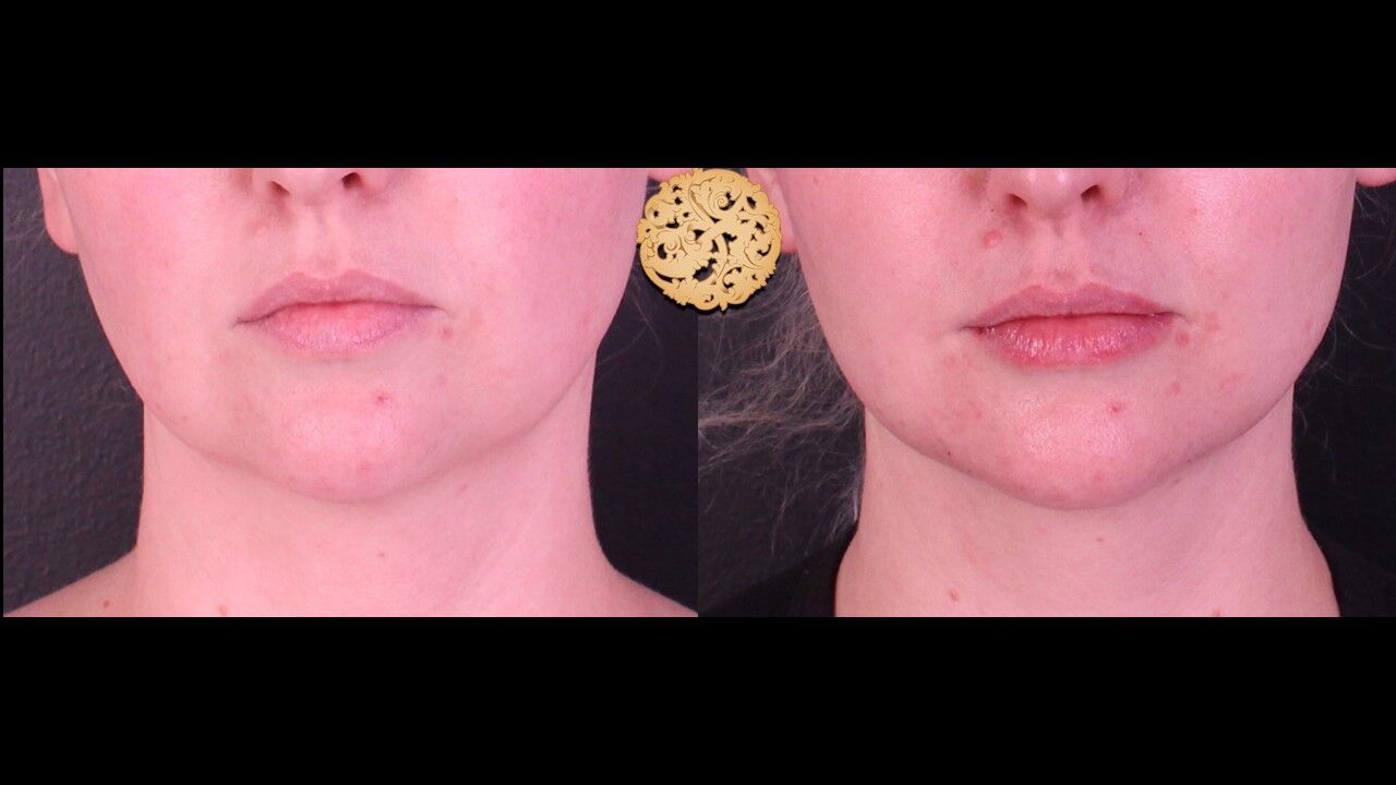 Lip Filler Before & After