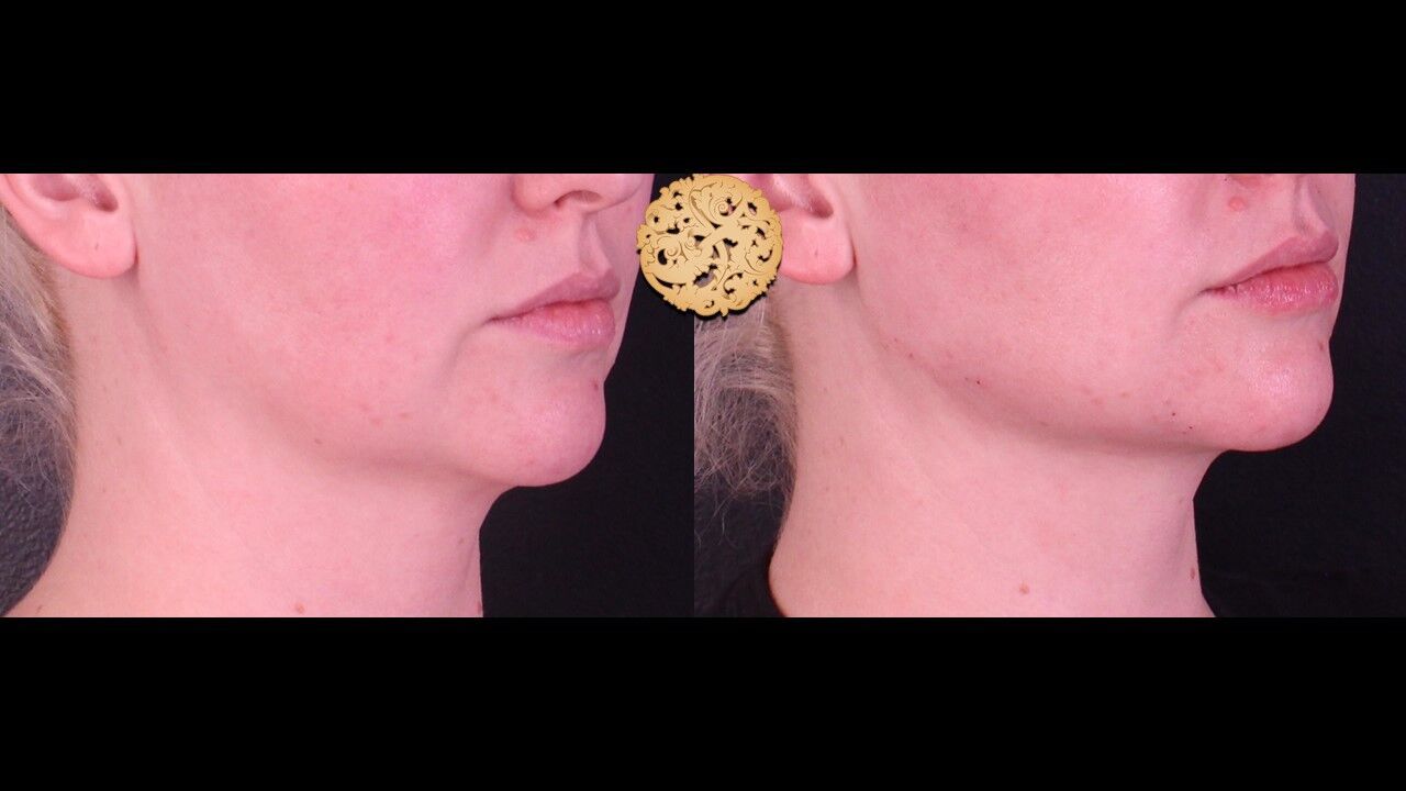 Lip Filler Before & After