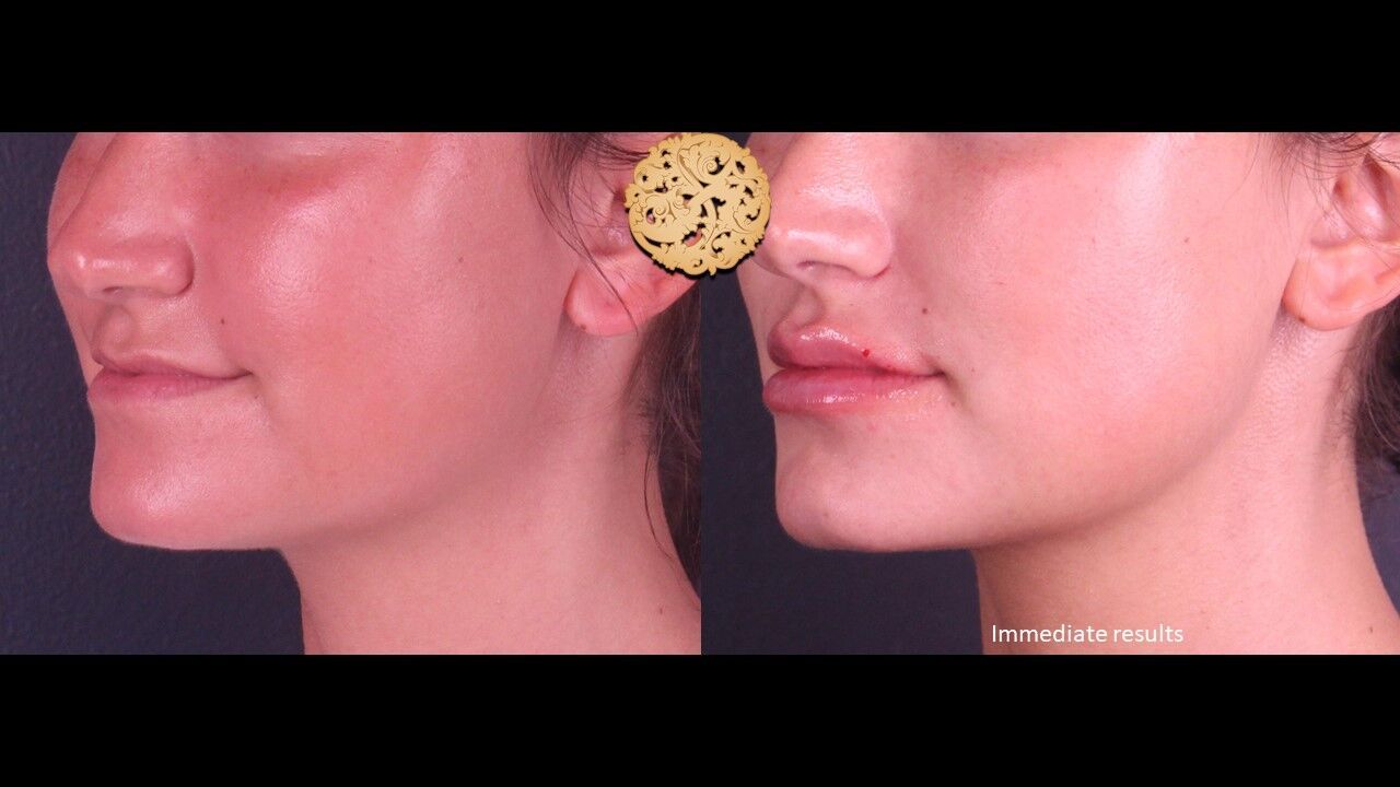 Lip Filler Before & After