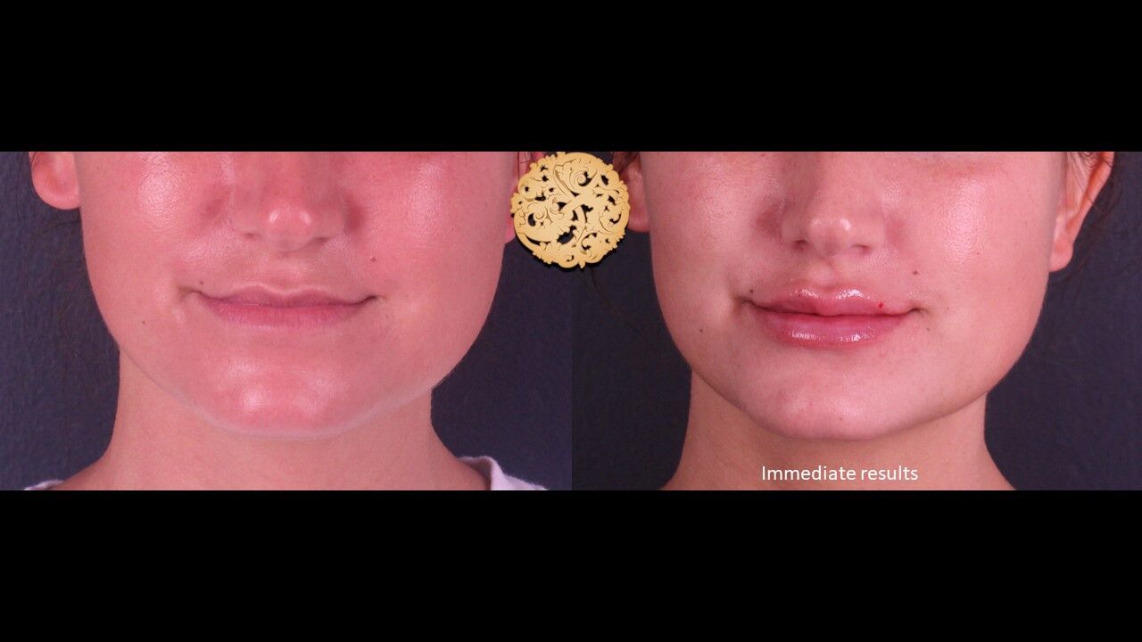 Lip Filler Before & After