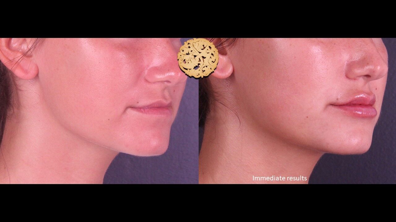 Lip Filler Before & After