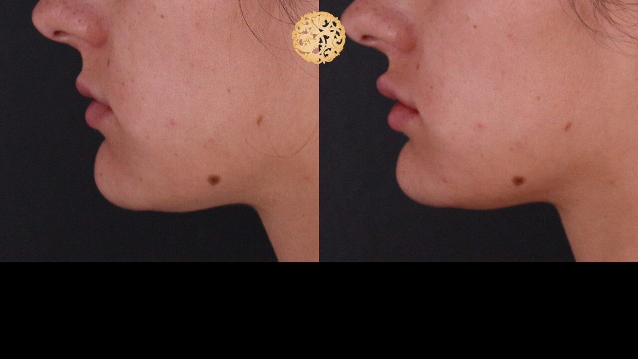 Lip Filler Before & After