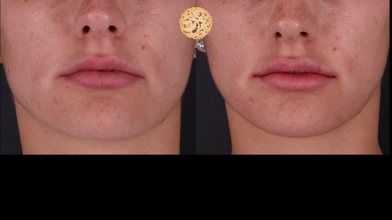 Lip Filler Before & After