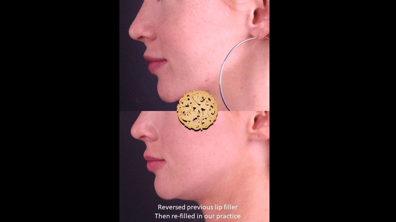 Lip Filler Before & After