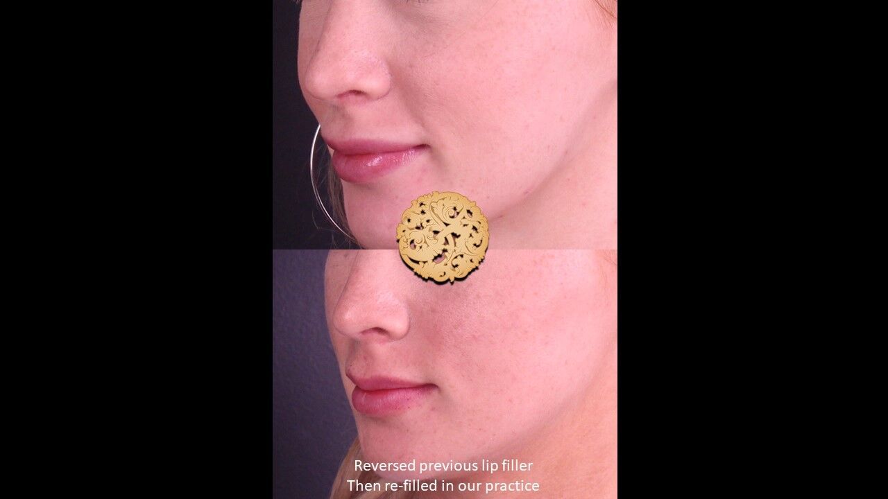 Lip Filler Before & After