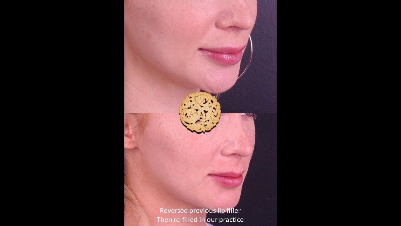 Lip Filler Before & After