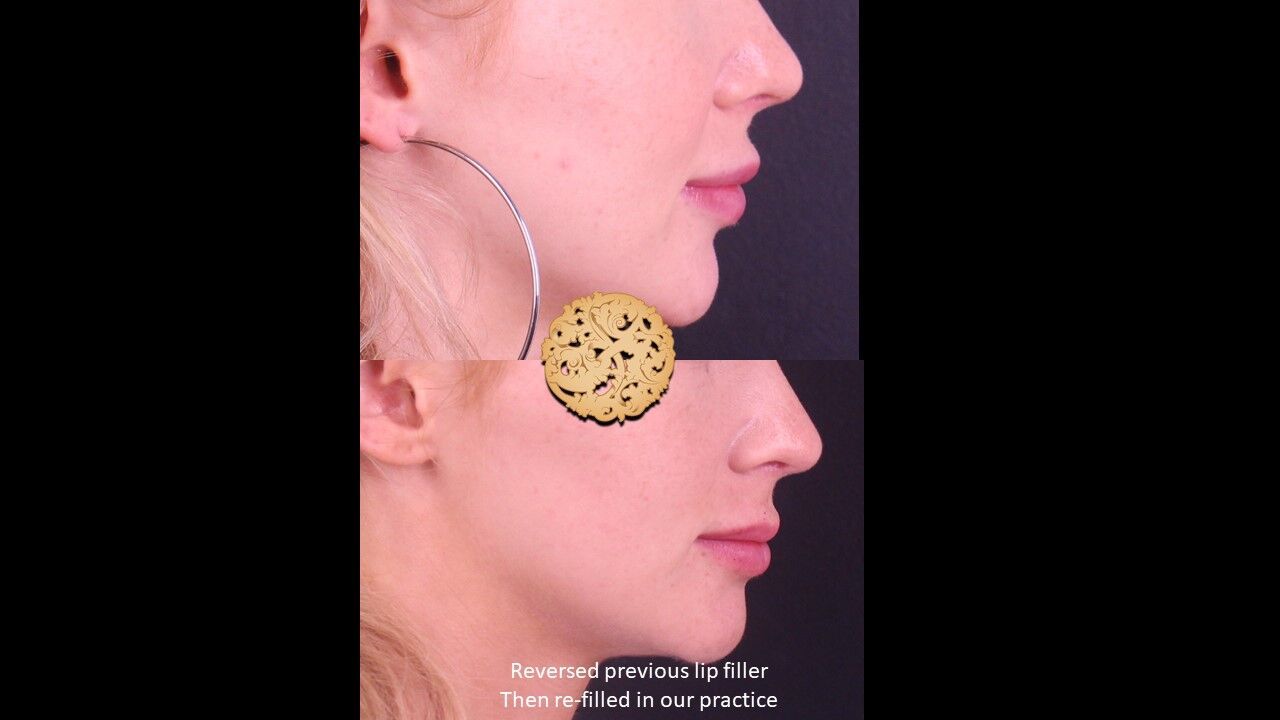 Lip Filler Before & After