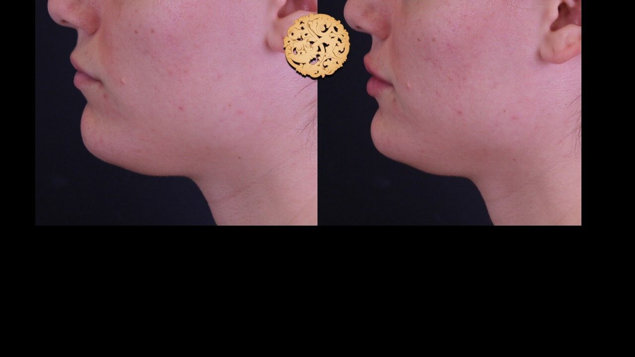 Lip Filler Before & After