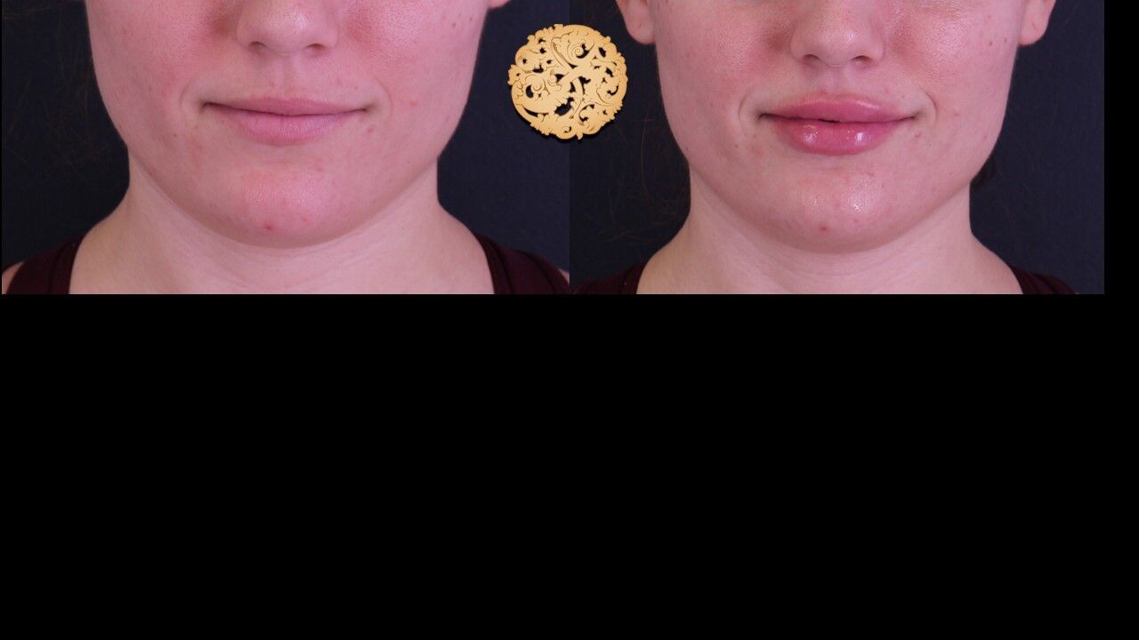 Lip Filler Before & After