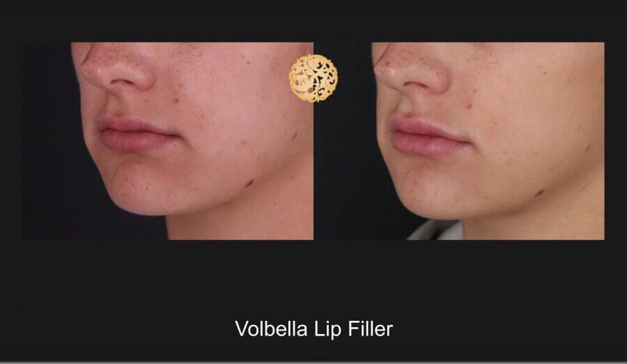 Lip Filler Before & After