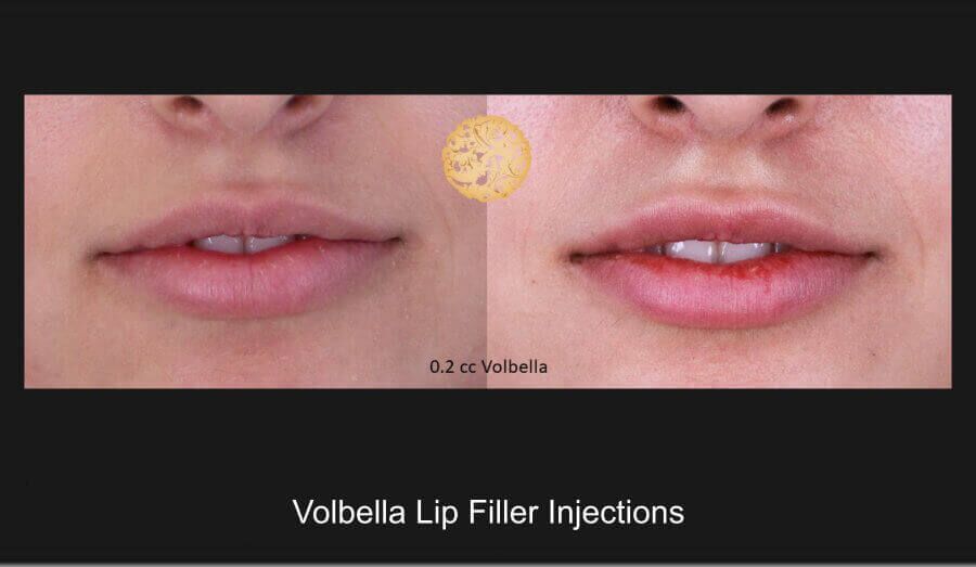 Lip Filler Before & After