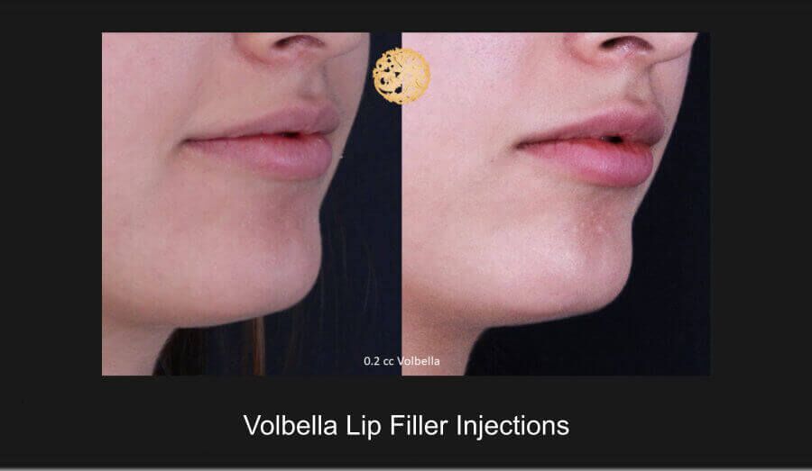 Lip Filler Before & After