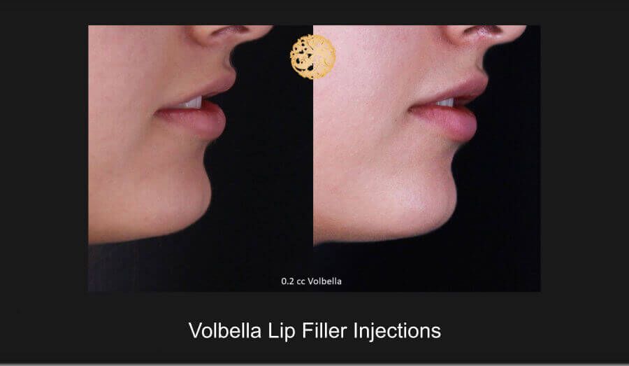 Lip Filler Before & After