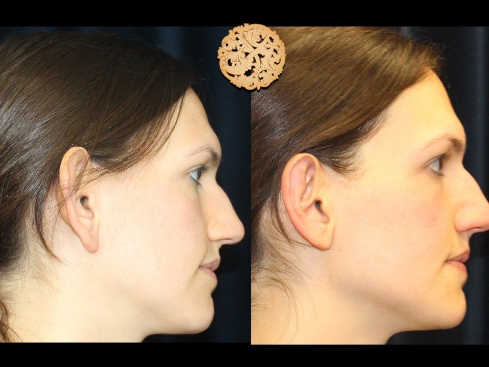 Earlobe Reduction Before & After