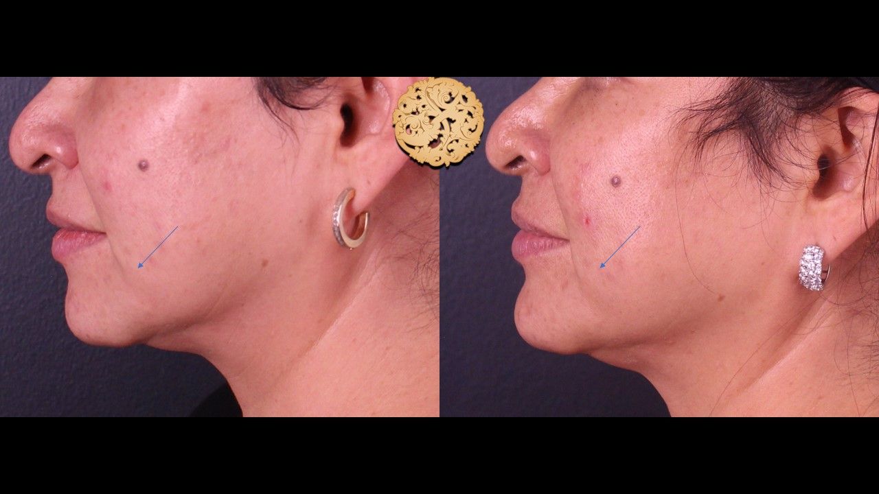 Kybella Before & After