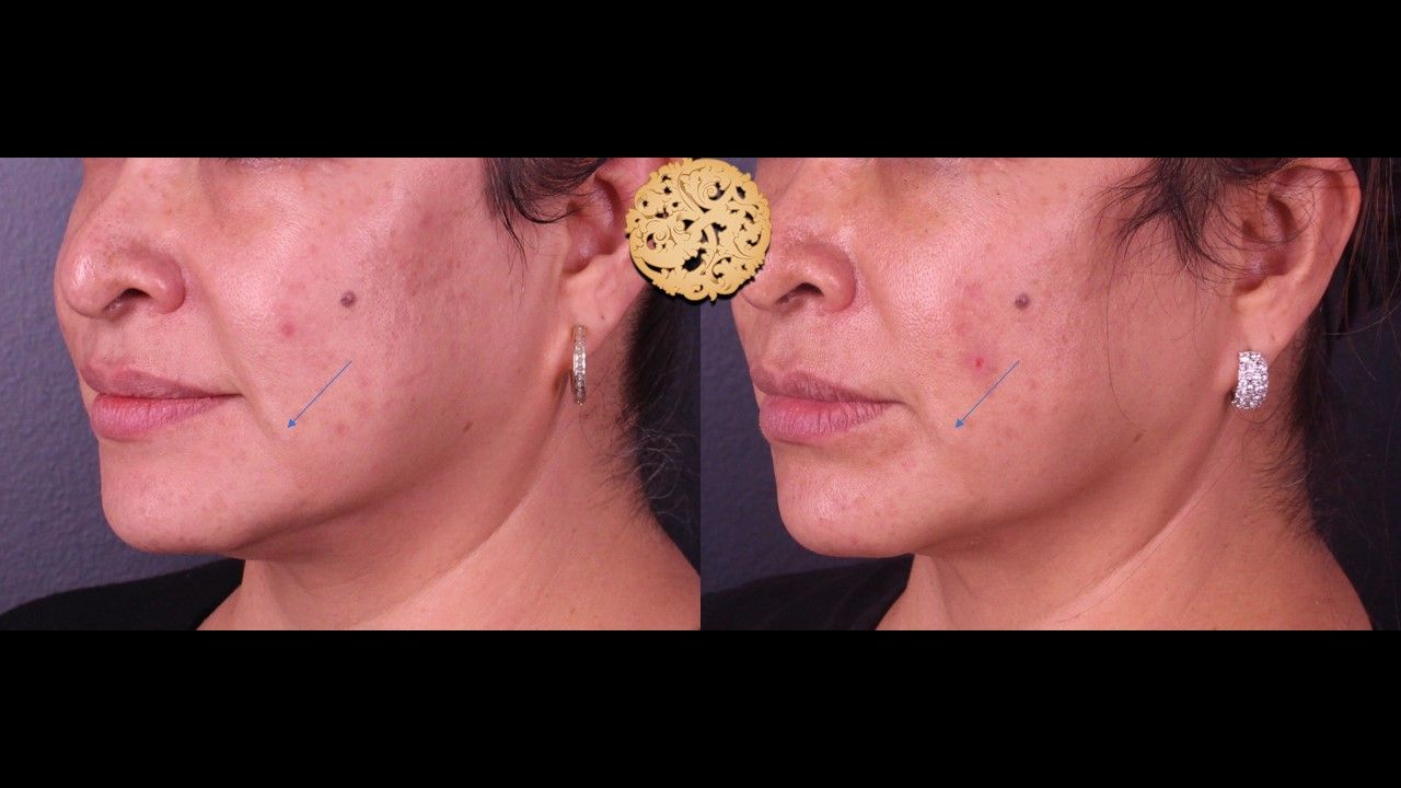 Kybella Before & After