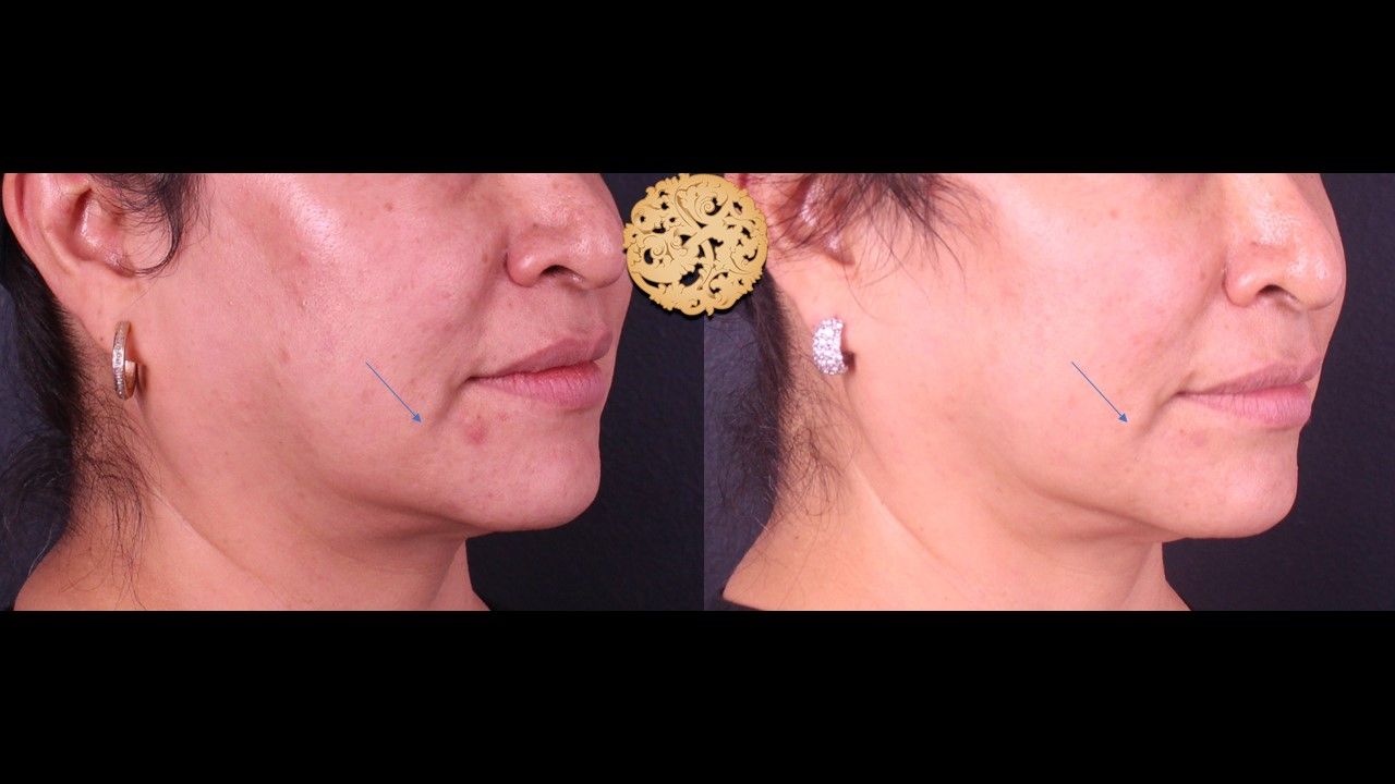 Kybella Before & After