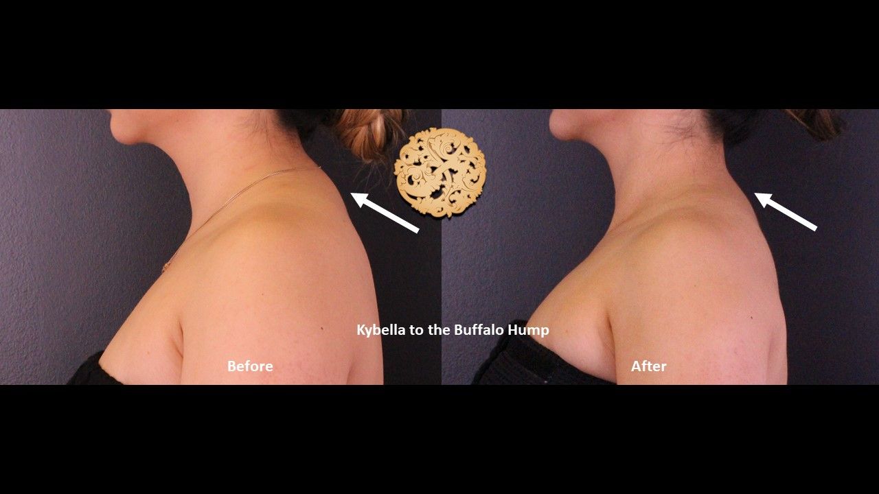 Kybella Before & After