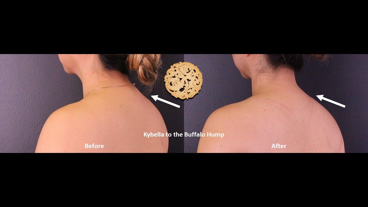 Kybella Before & After