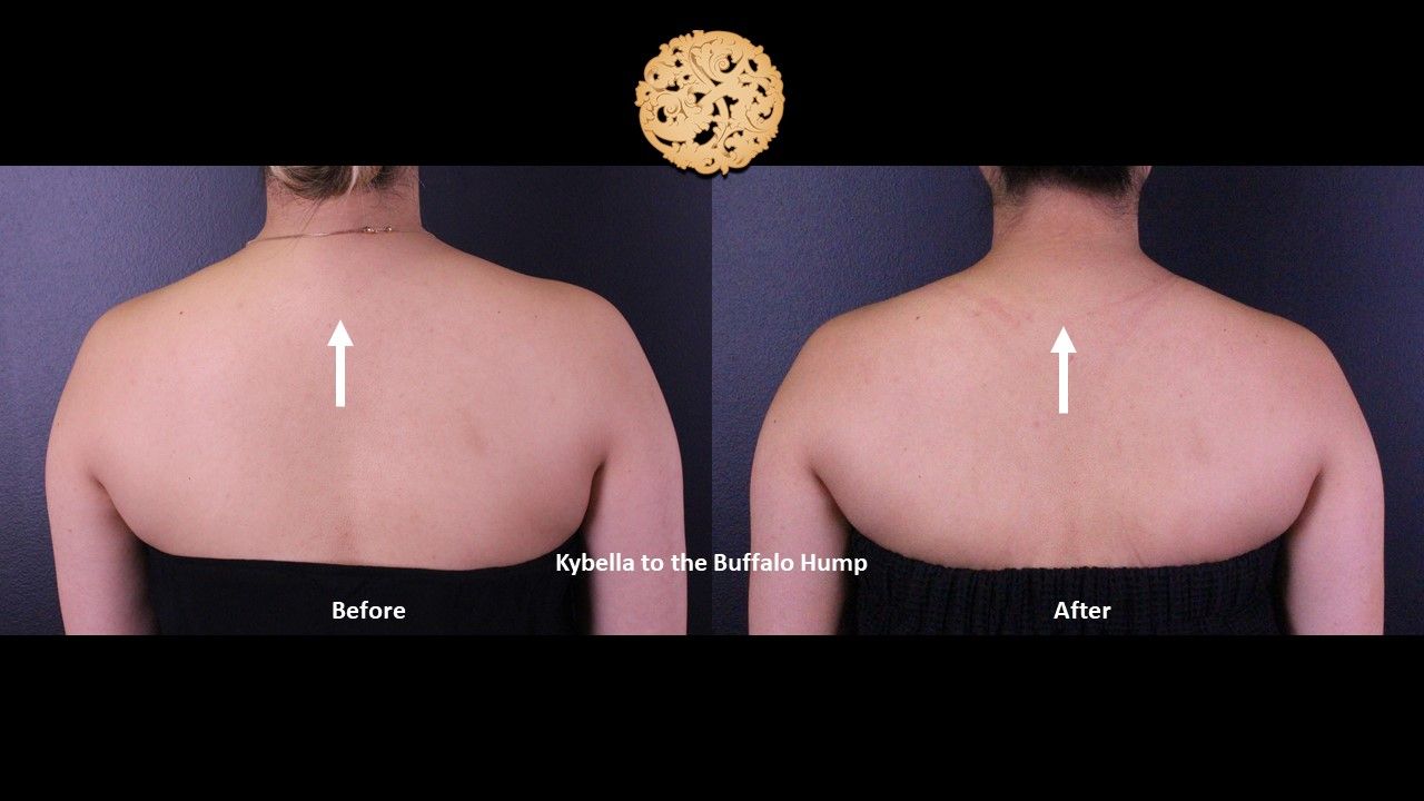 Kybella Before & After
