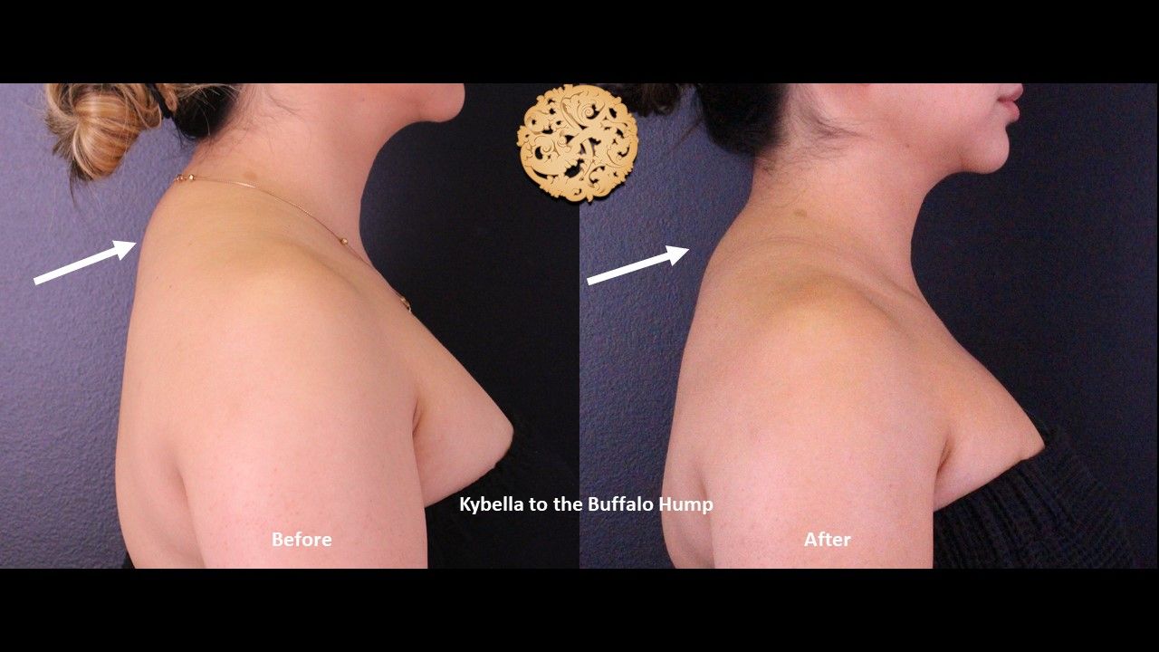 Kybella Before & After
