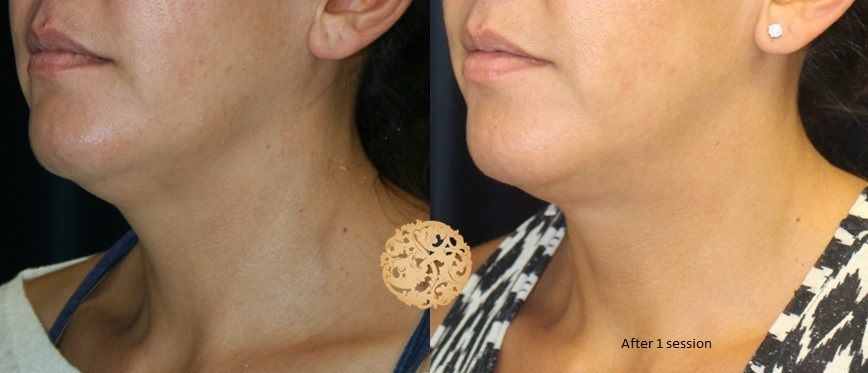 Kybella Before & After