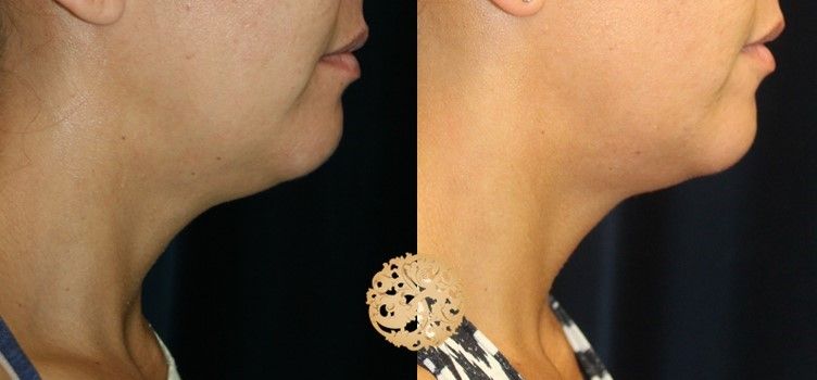 Kybella Before & After