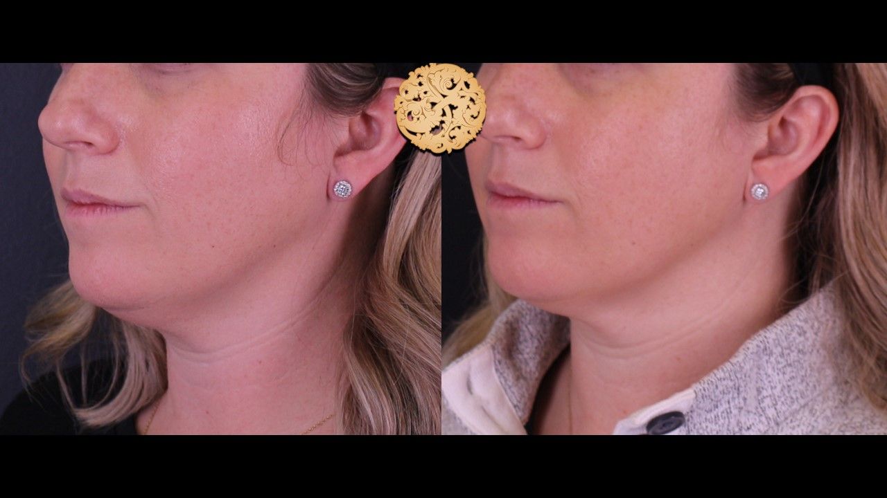 Kybella Before & After