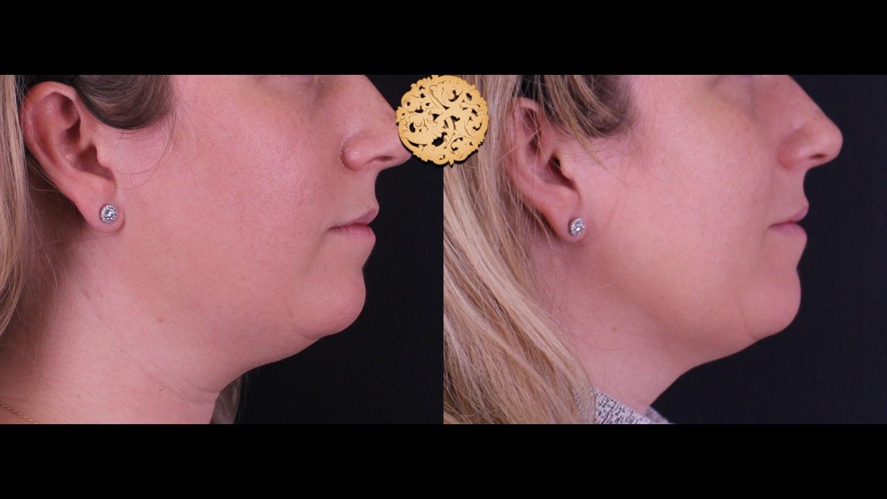 Kybella Before & After