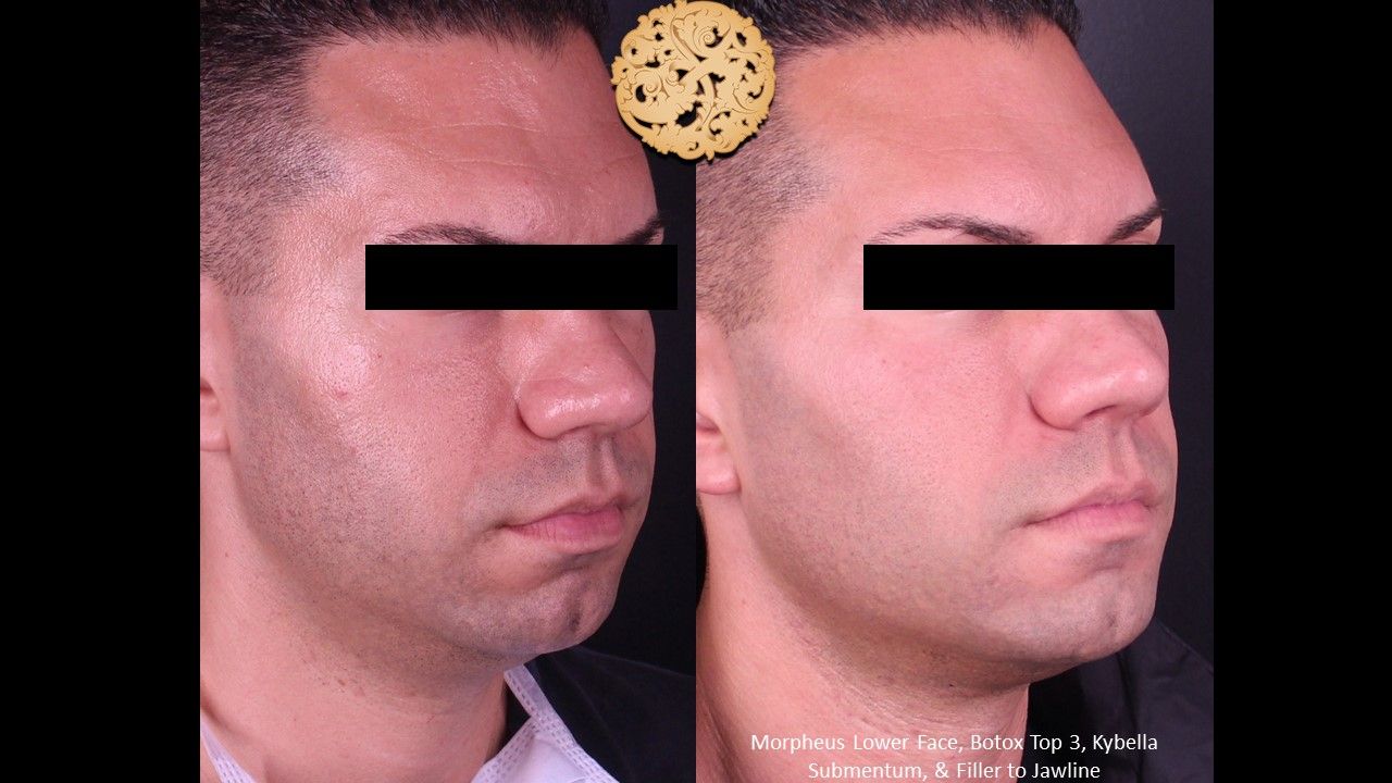 Kybella Before & After