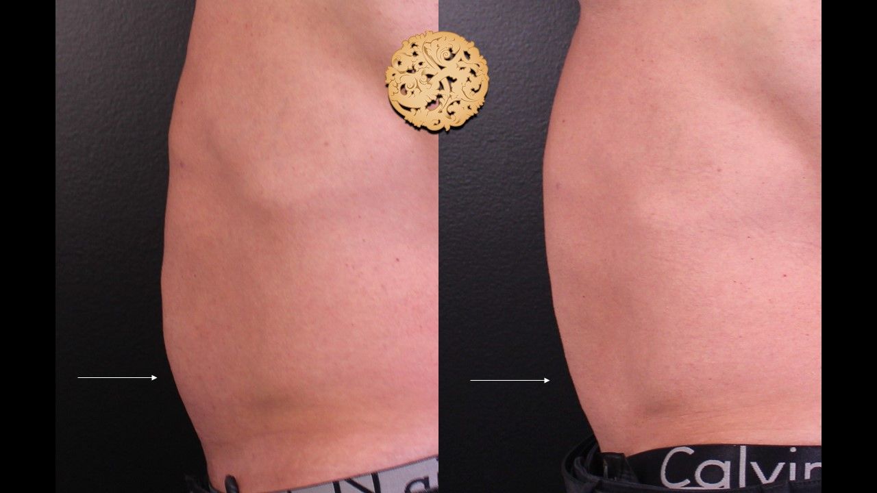 Kybella Before & After