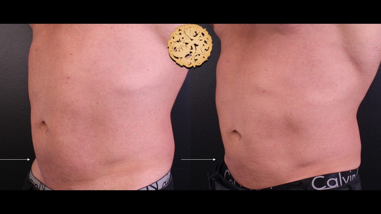 Kybella Before & After