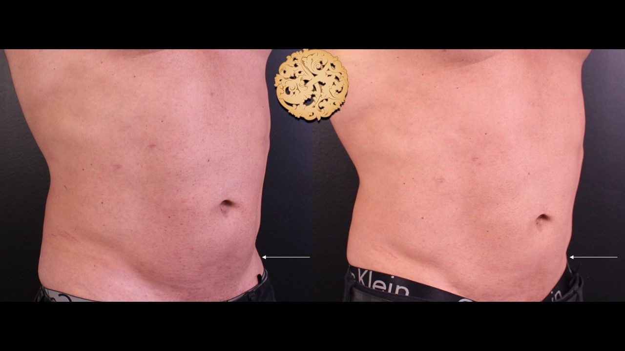 Kybella Before & After