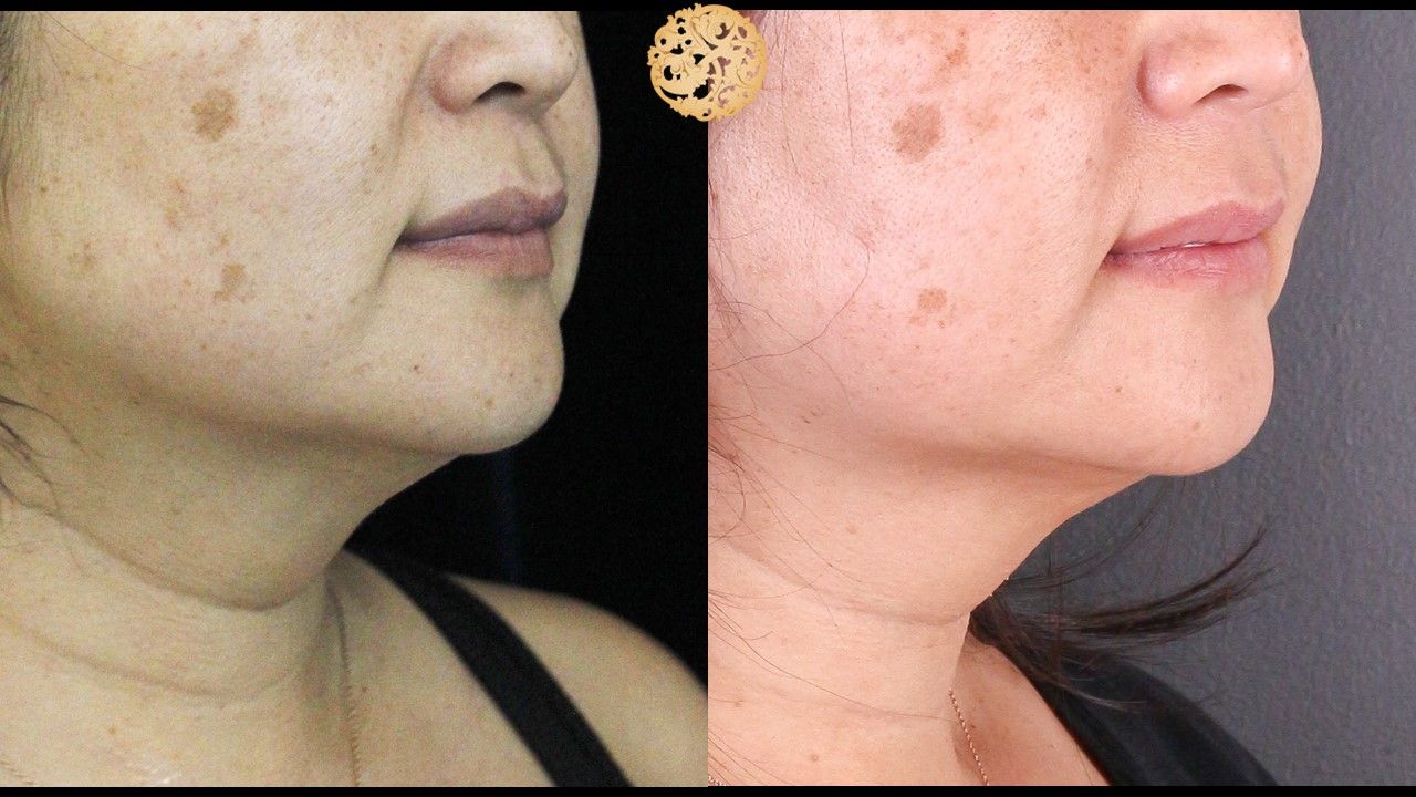 Kybella Before & After