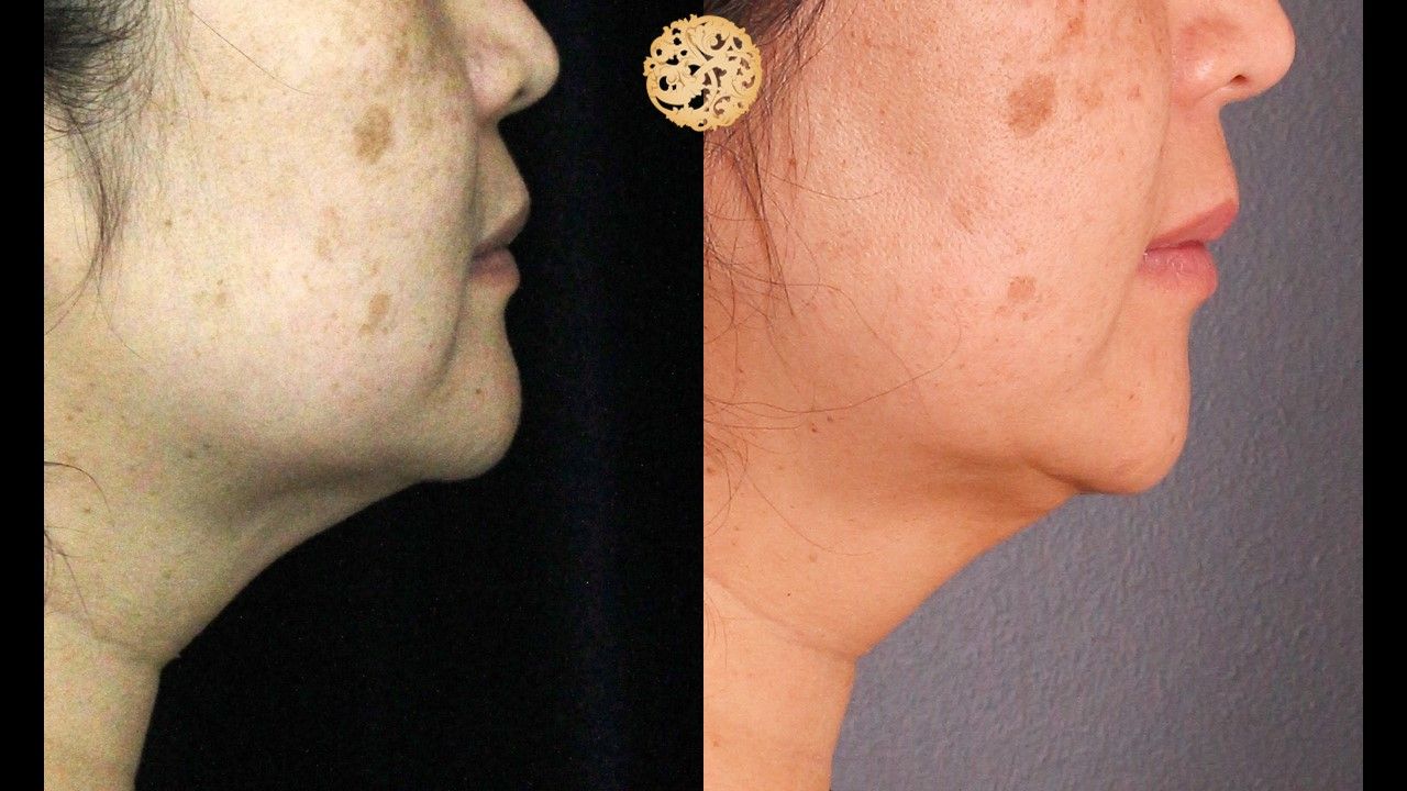 Kybella Before & After