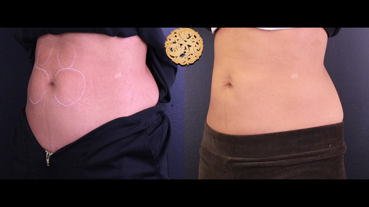 Kybella Before & After