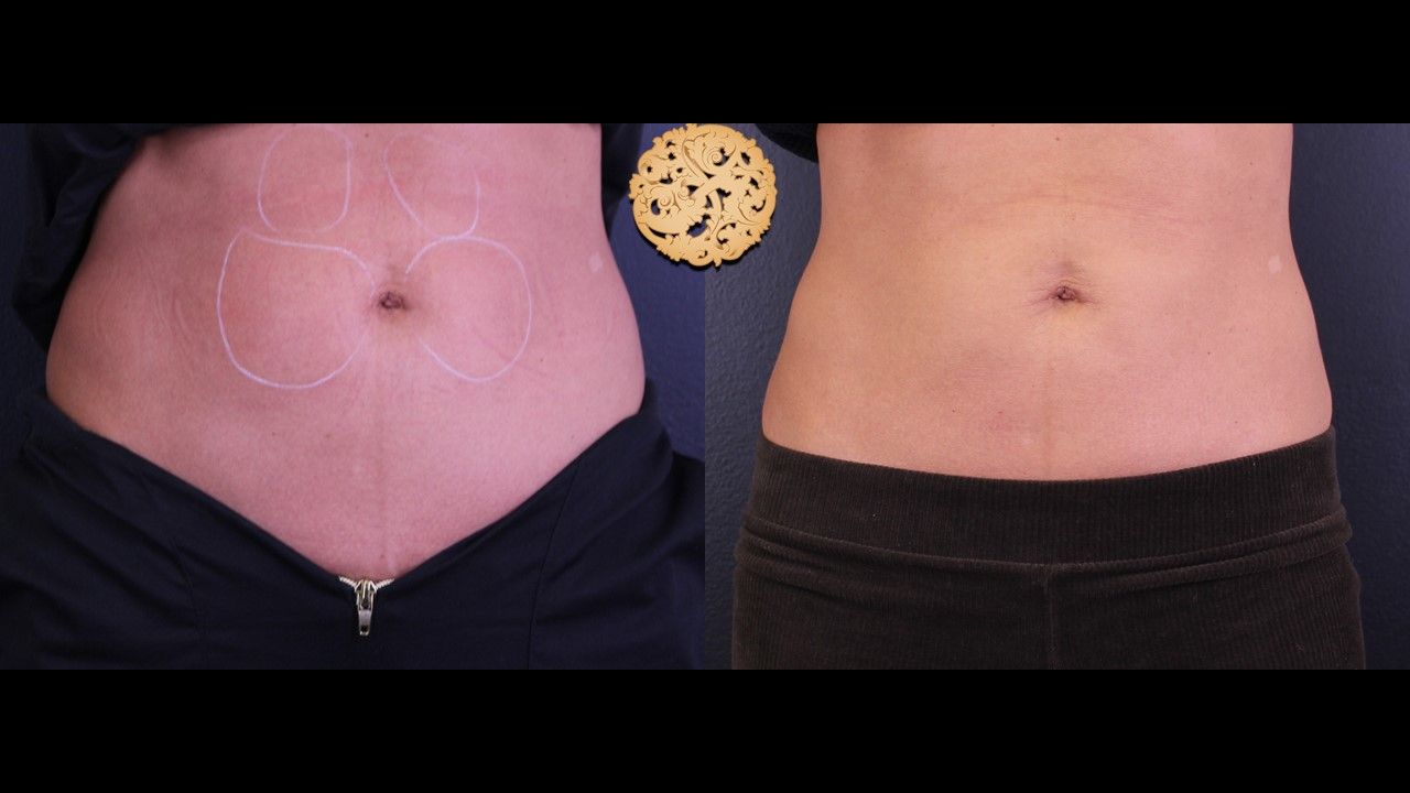 Kybella Before & After