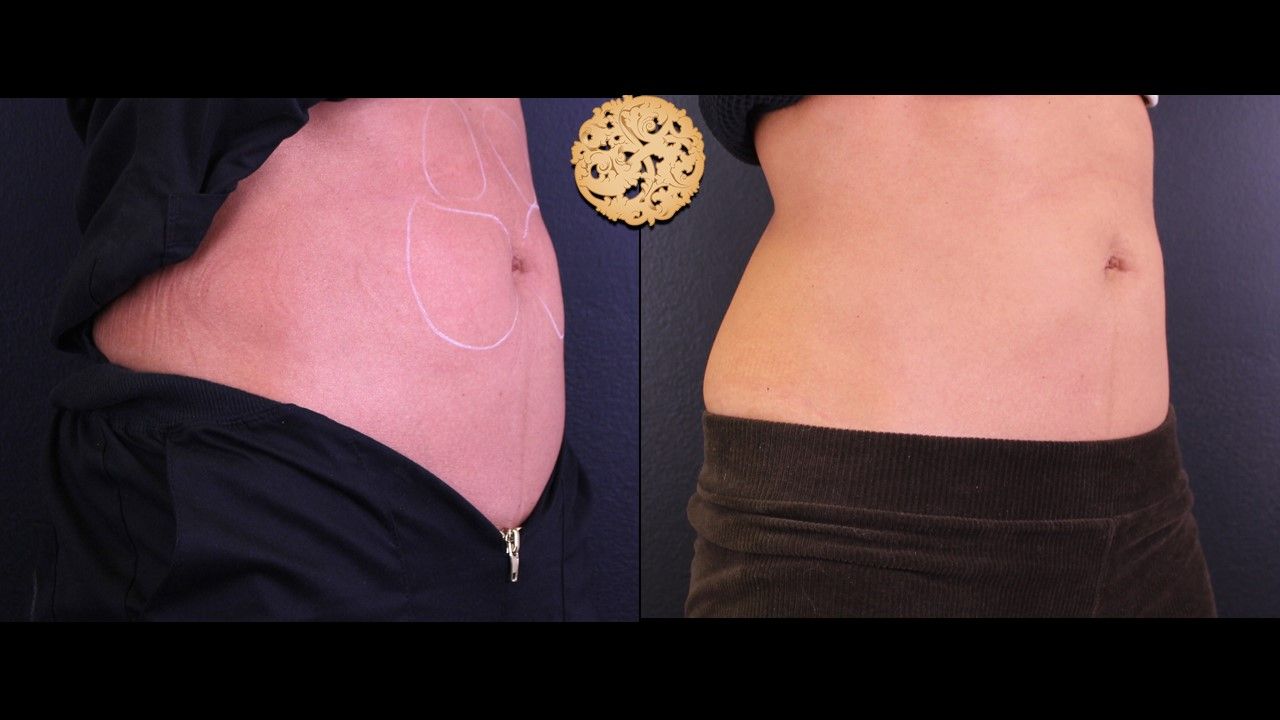 Kybella Before & After