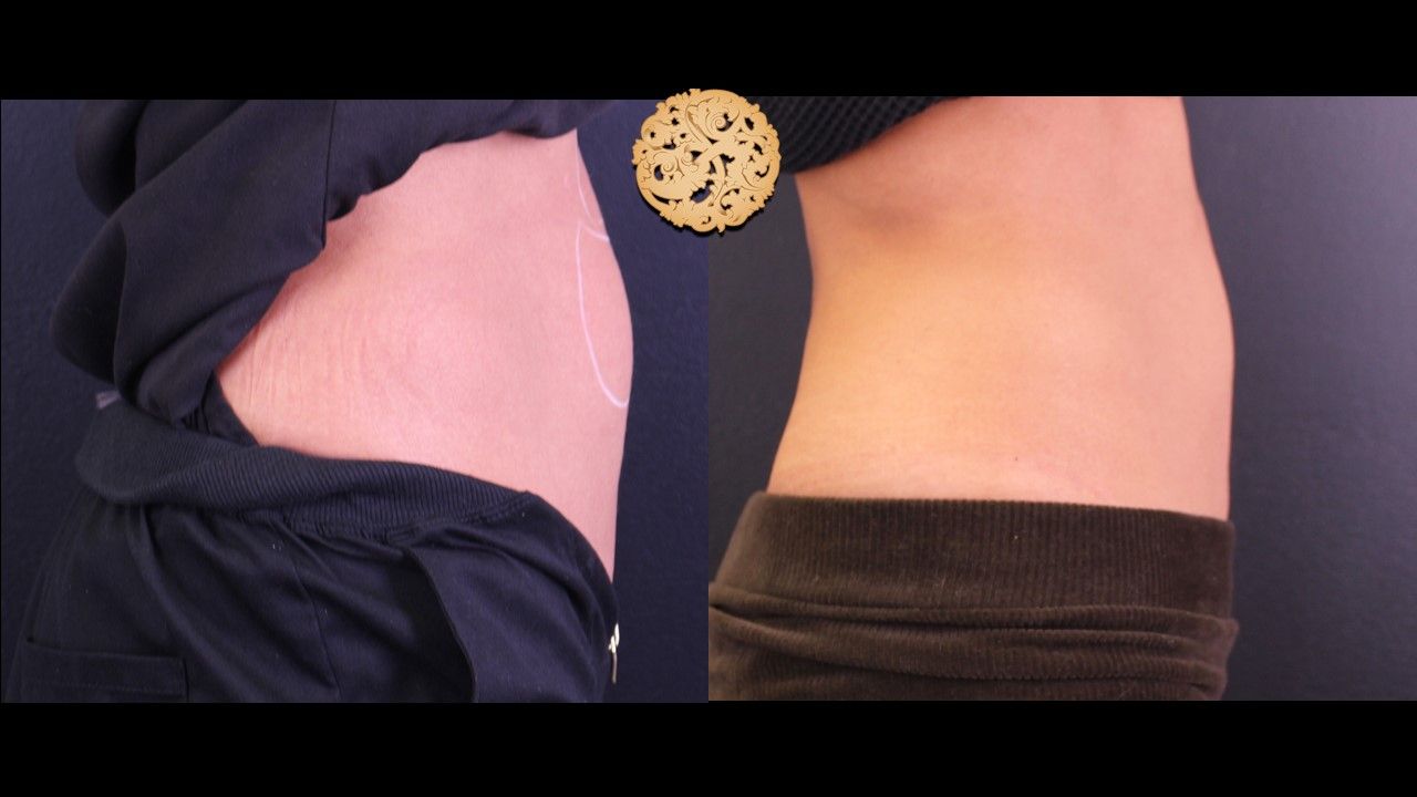 Kybella Before & After