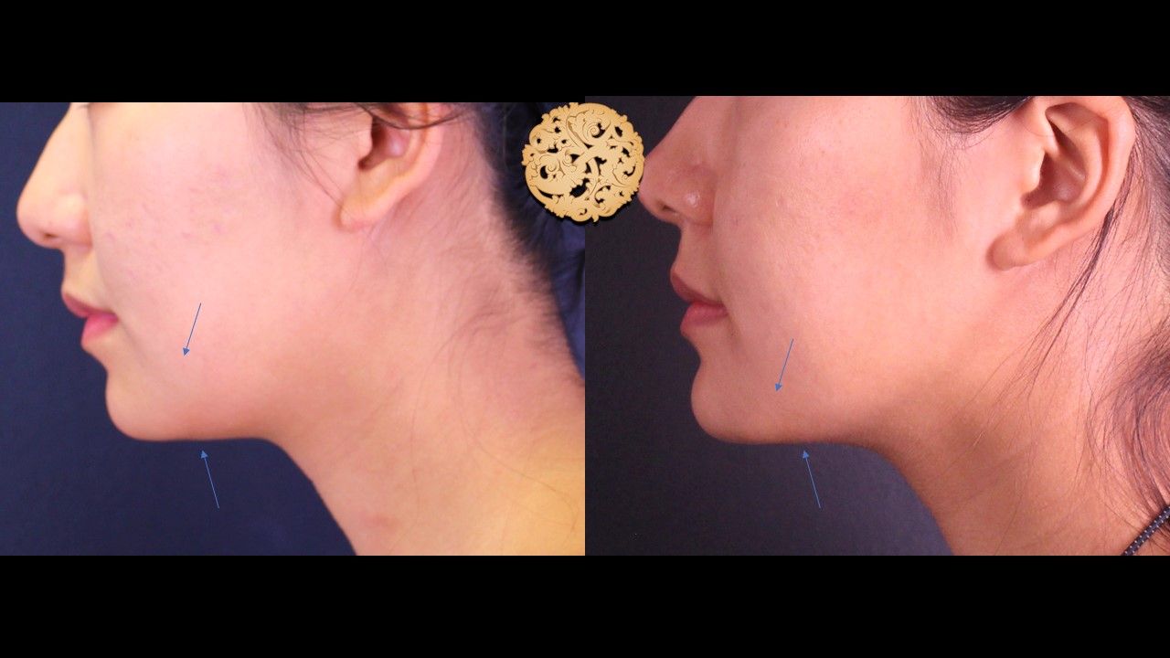 Kybella Before & After
