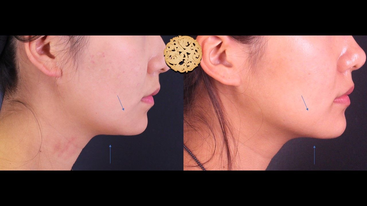 Kybella Before & After