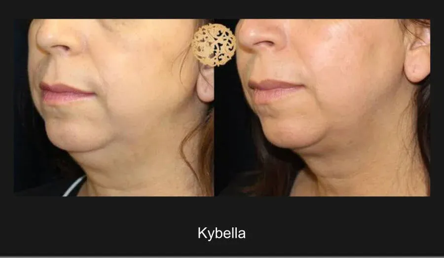 Kybella Before & After