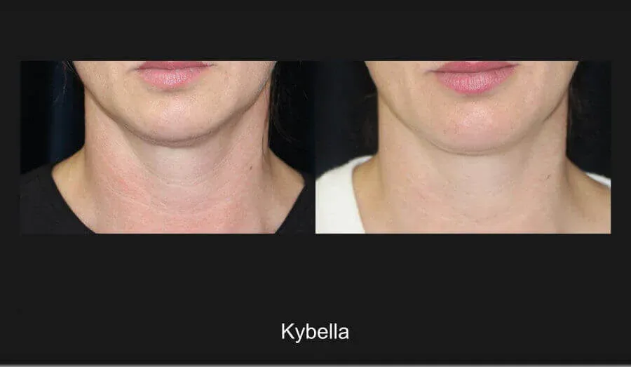 Kybella Before & After
