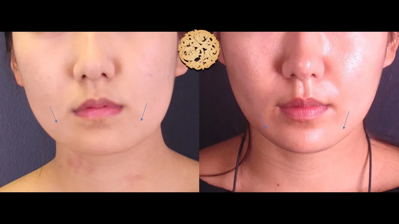 Kybella Before & After